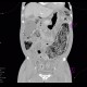 Toxic megacolon, pneumoperitoneum: CT - Computed tomography